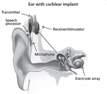 speech recognition test cochlear implants