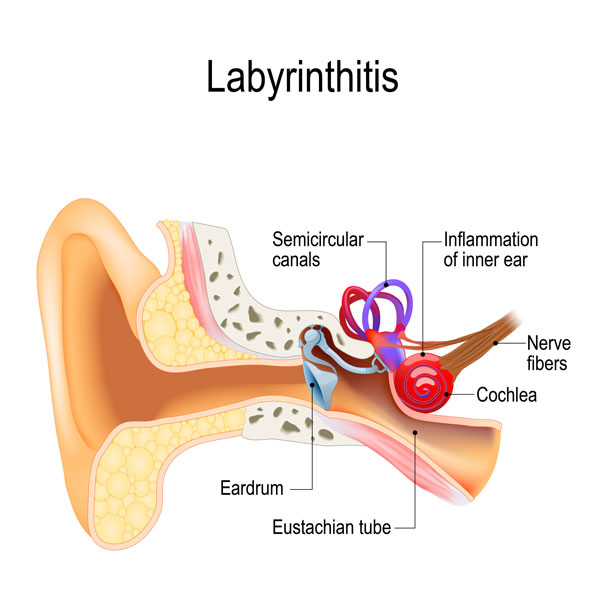 Labryrinthitis graph